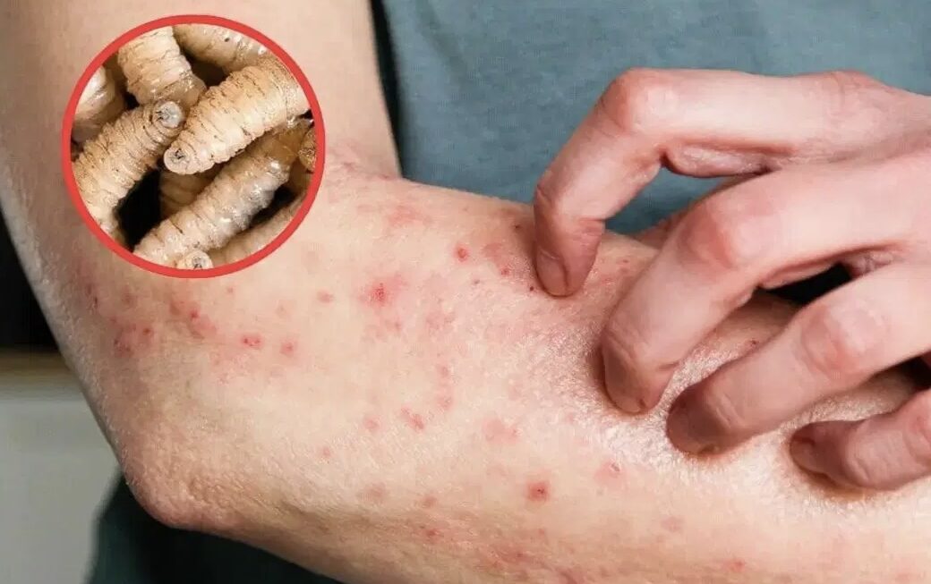 169 casos de gusano barrenador en humanos en Honduras confirma SESAL 