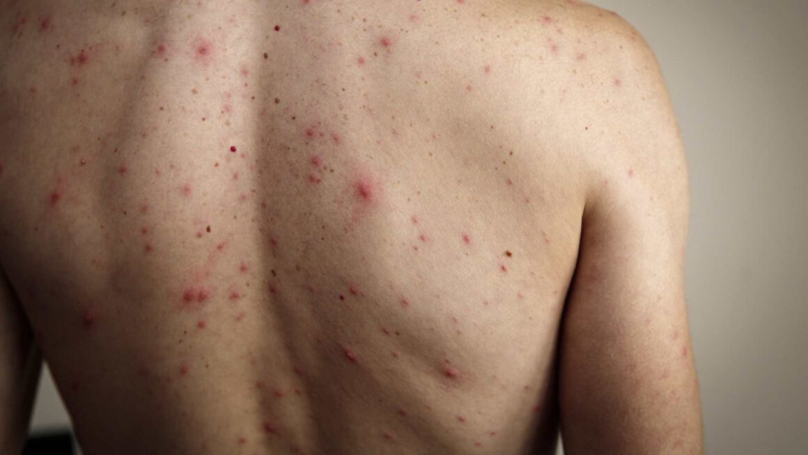 Salud reporta primer caso sospechoso de sarampión en Honduras 