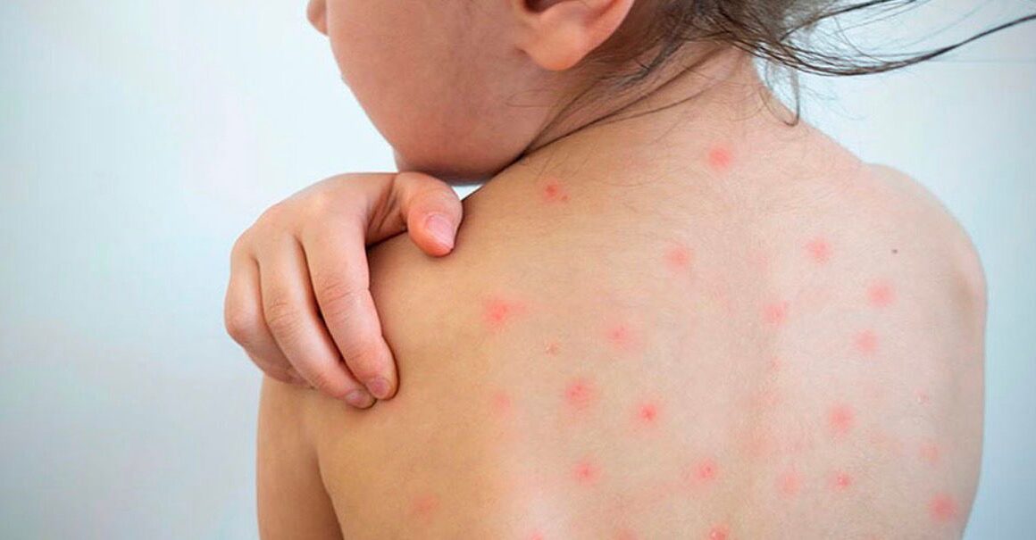 Autoridades alertan por cinco casos sospechosos de sarampión en Honduras